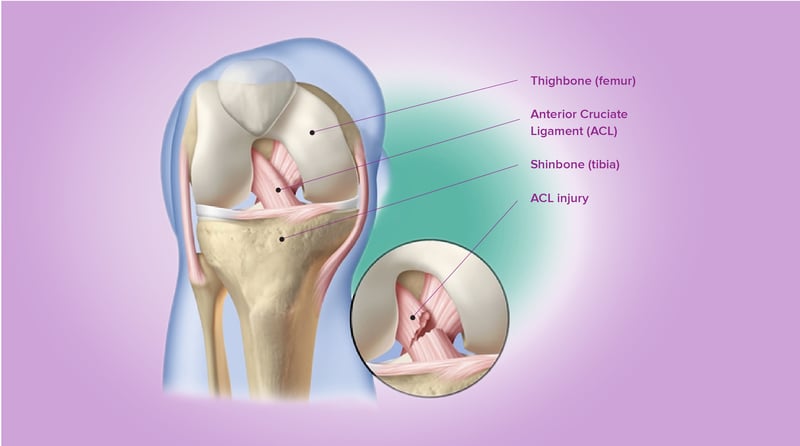 Anterior Cruciate Ligament (ACL) Injury