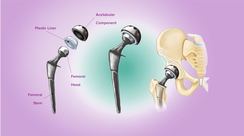 content_joint_replacement1-body