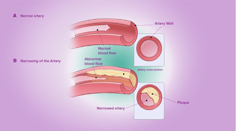 content_stenosis1-body